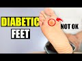 How to Take Care of Diabetic Feet &amp; Avoid Neuropathy