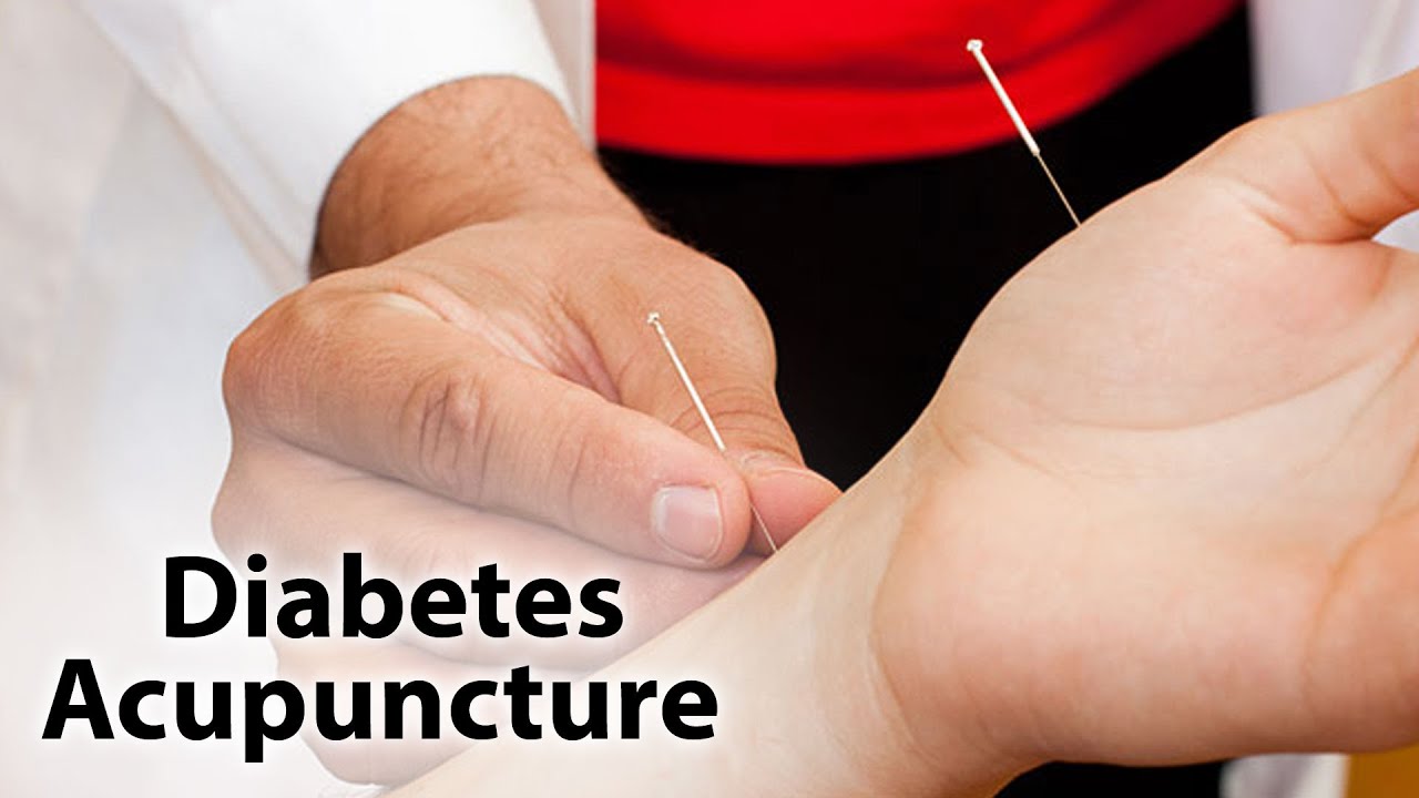 Acupuncture for Diabetes Body n Soul Part 2 YouTube