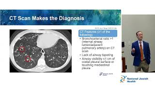 Overview of Bronchiectasis