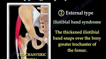 Snapping Hip Syndrome , causes , diagnosis and treatment. Click in the hip what does it mean?