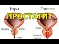 Что такое простатит простыми словами