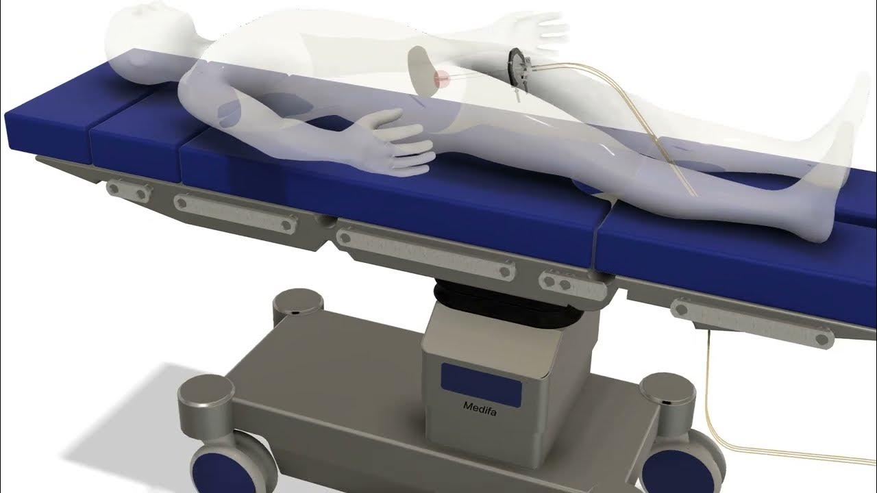Side Effects Internal Radiation Uterine Cancer