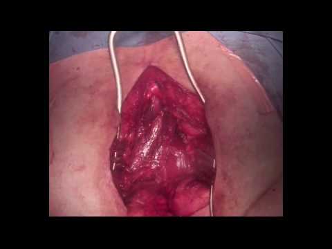 Pelvic Floor Reconstruction With Bilateral Gracilis Flaps After Extralevator APE