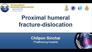Proximal humeral fracture-dislocation By Dr.Chitpon Sinchai from Phatthalung hospital