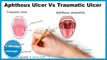 Aphthous ulcer/stomatitis Vs Traumatic ulcer