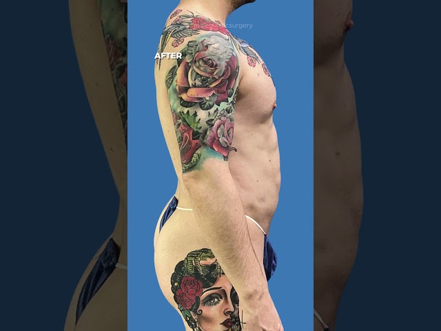 Male Body Transformation | Liposuction + Pectoral Implants + BodyBanking&reg;