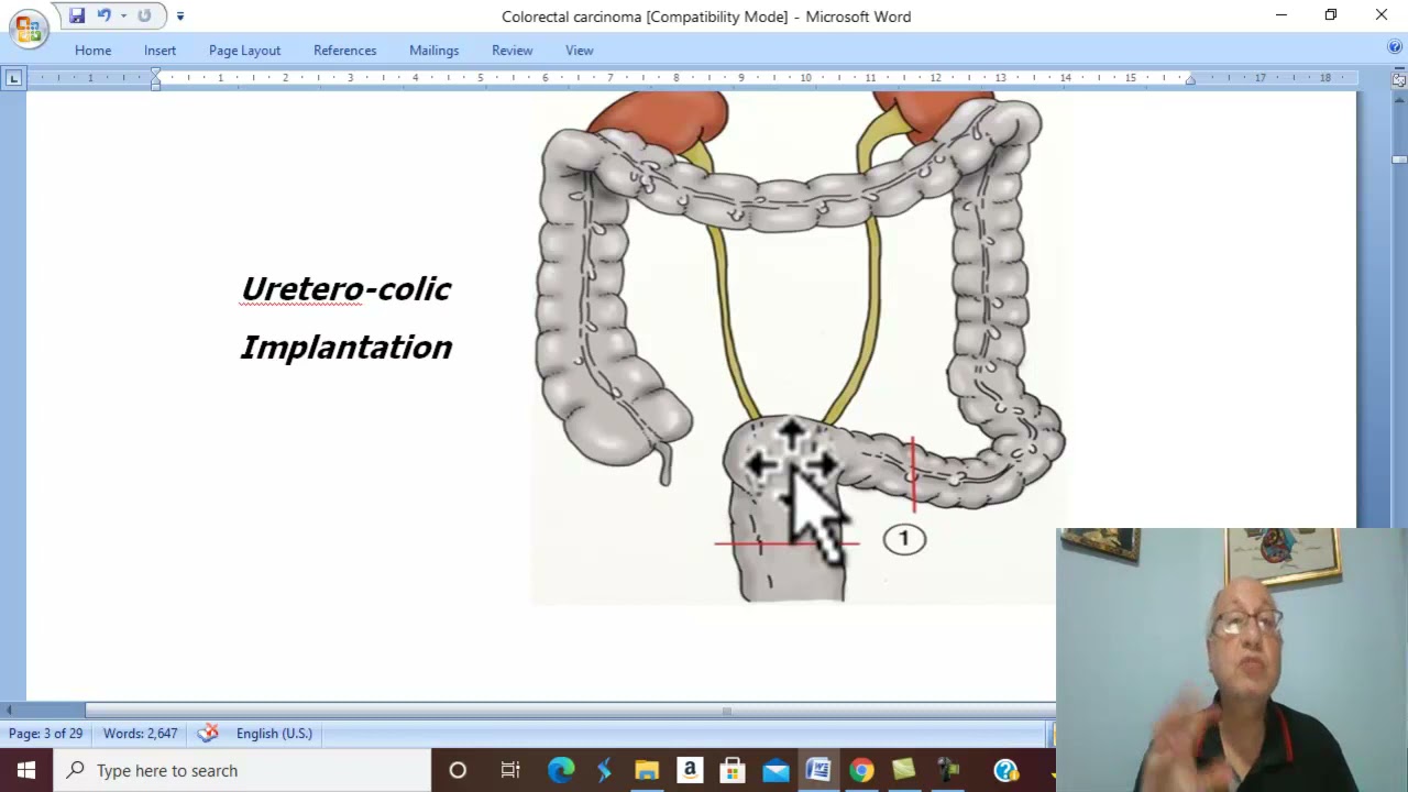 GIT Tumors in Arabic 12  ( Colo-rectal Carcinoma , part 1) , by Dr. Wahdan