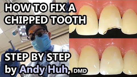 How to fix a chipped/broken tooth, dental bonding, composite Pasta Evergreen Dental, Billerica, MA