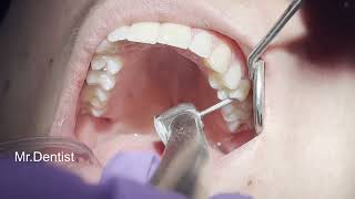 Tooth Filling Procedure   !!!