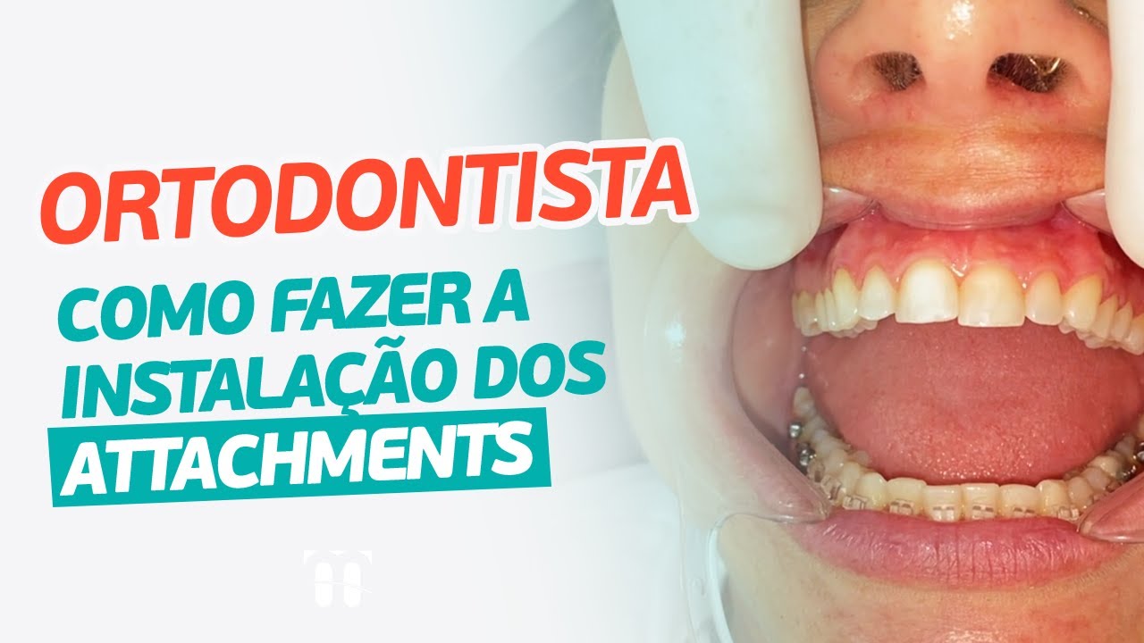 Dica de Ortodontia: Como instalar Attachments para aparelhos ortodônticos