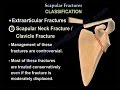 Scapular Fractures, types and treatment - Everything You Need To Know - Dr. Nabil Ebraheim