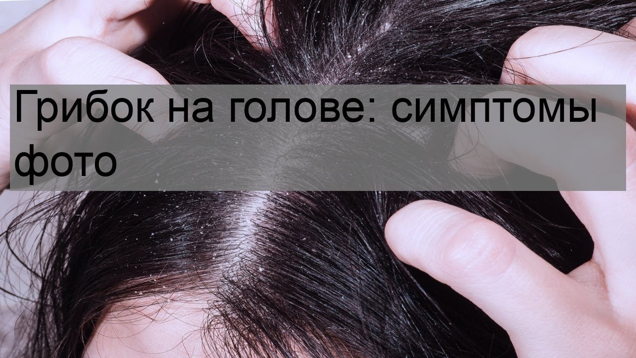 Грибок на голове: симптомы фото