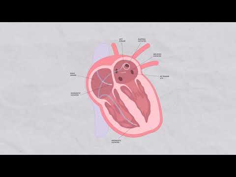 What is a Cardiac Ablation?