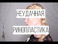 УЖАСЫ НЕУДАЧНОЙ РИНОПЛАСТИКИ