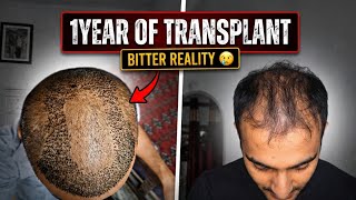 14-month hair transplant update || Harsh reality of transplant 😢 || Watch this before getting a h...