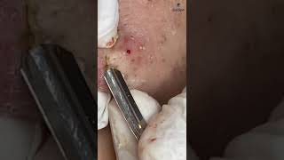 A blackhead extraction at Ga Spa Clinic #gaspa #phongkhamdalieu #acne #shortsvideo