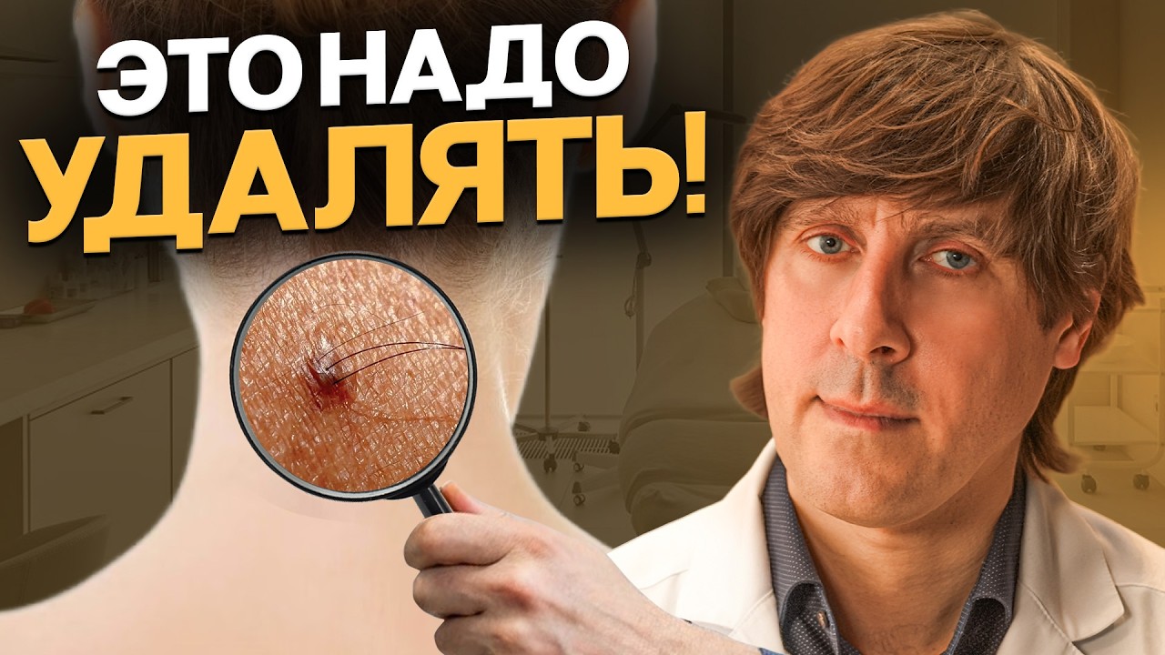 У ВАС РАК? ПРОСТОЙ способ РАСПОЗНАТЬ какие родинки ПРЕВРАЩАЮТСЯ в РАК!