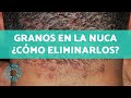 GRANOS EN LA NUCA - Causas y remedios para ELIMINARLOS 🤚🏼