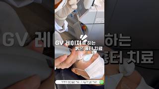 아무리 약을 발라도 재생되지 않는 붉은 자국🥲GV레이져로 마취 없이도 안아프게붉은 색소와 혈관을 치료 할 수 있습니다🍀 #붉은색소 #붉은흉터 #흉터치료