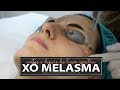 Antes e Depois do meu tratamento de Melasma com laser Spectra Nd:YAG Q-Switched