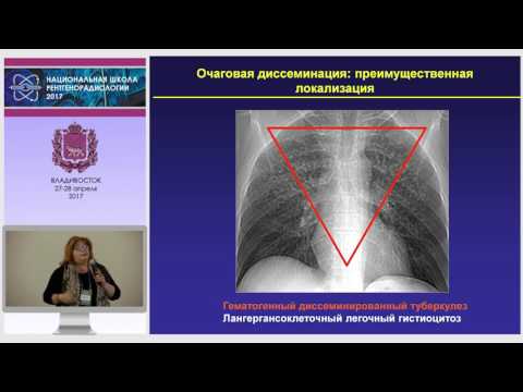 И.А. Соколина - Дифференциальная диагностика очагов и очаговой диссеминации легких