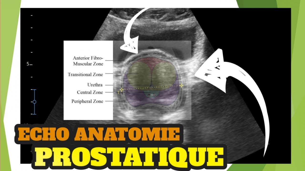 Echographie de prostate: écho anatomie