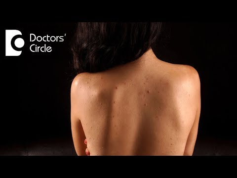 Photodynamic Therapy to treat Back Acne in adults - Dr. Rajdeep Mysore