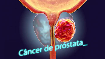 Quais são os exames para detectar câncer de próstata?
