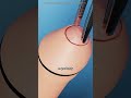 Laser Circumcision Surgery (3D Medical Animation )#lasercircumcision #laserCircumcision