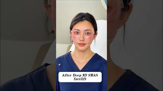 #facelift #kpop #lifeisbutadream #exo #kdrama #deep9dfacelift