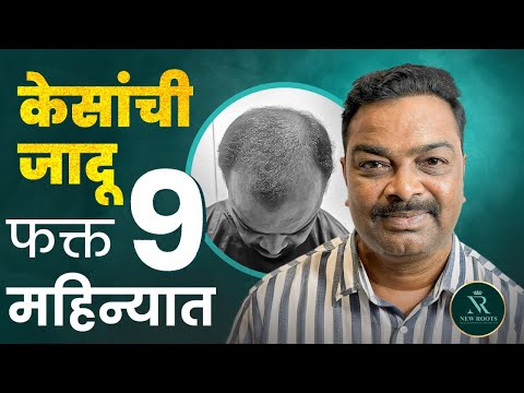 5000 Grafts Hair Transplant Before & After 🤩 | Grade 5 Baldness | New Roots Vashi