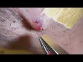 Plucking facial hair & ingrown hair 1009 喉髭抜き(埋没毛あり)