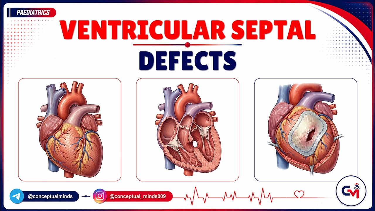 Vsd Management 25. Ventricular Septal Defect (VSD): Pathophysiology, Murmurs, and ...
