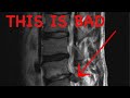 How to Read a Spine MRI