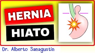 HERNIA DE HIATO  Causas, Síntomas, Clasificación y Tratamiento