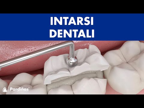 Video: Cos'è un intarsio dentale?