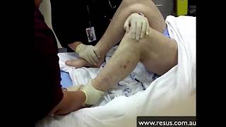 Hip Relocation Made Easy