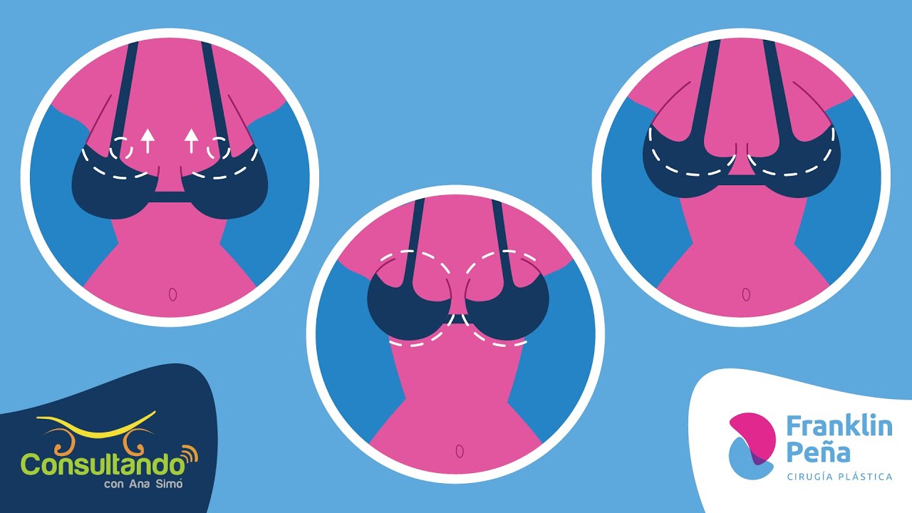 Lo que debes SABER sobre la MAMOPLASTIA (Aumento de senos con IMPLANTES) | Consultando con Ana Simó