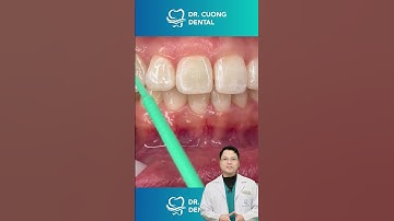 Bắt đầu hành trình niềng răng |Dr Cường Official