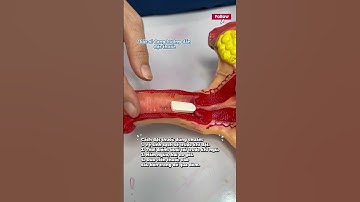 Cách đặt thuốc phụ khoa chuẩn.  #bstranhanhnhan #myphap #sankhoa #thuocphukhoa