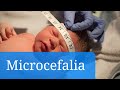 Microcefalia. Información sobre las causas y el diagnóstico de este trastorno