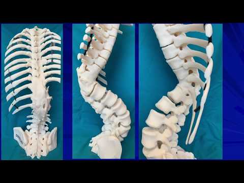 Video: Kyphoscoliosis, Kyphoscoliosis Of The Thoracic Spine