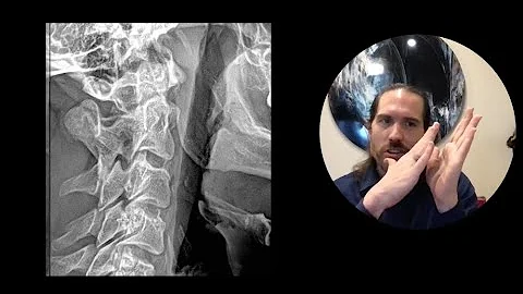 Brain Fatigue in Neck Health, Concussion, Whiplash | Upper Cervical Chiropractor Spokane