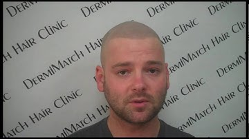 Von (Part 2) - DermiMatch fixing bad transplants and bad SMP