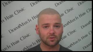 Von Part 2 - Dermimatch Fixing Bad Transplants And Bad Smp