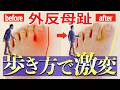 【手術はやめて!】外反母趾は歩き方で改善します