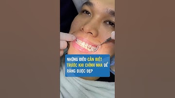 Những điều cần biết trước khi Niềng Răng