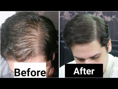 Rosemary Oil for Hair Loss - My Results w/ Pictures Before & After - How To Use