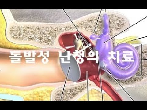 돌발성 난청 - 돌발성 감각신경성 난청의 원인 / 증상 / 치료 / 경과