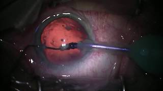 Cataract Surgery: 